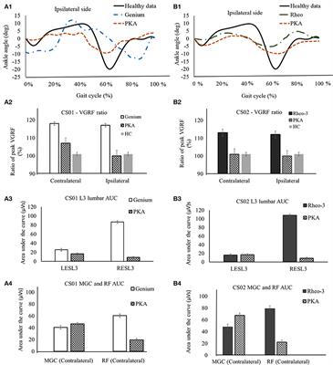 Impact of Powered Knee-Ankle Prosthesis on Low Back Muscle Mechanics in Transfemoral Amputees: A Case Series